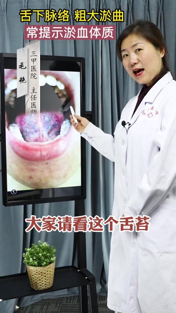 舌诊案例:舌下脉络粗大瘀曲,常提示血瘀体质