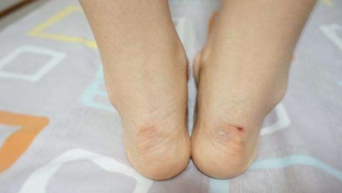 鞋子磨脚疼痛难忍,用这招,仅需一晚上鞋子再也不会磨脚!