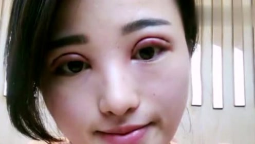 内蒙两女子做双眼皮,一个眼球上留长线,一个手术针"落