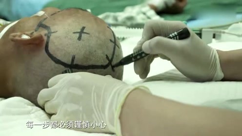 男子脑袋摔伤脑出血昏迷送医院急救,医生紧急开颅手术清除血肿