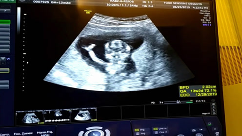 怀孕13周四维彩超产检实录,幸运的拍到了宝宝朝我们挥手致意!