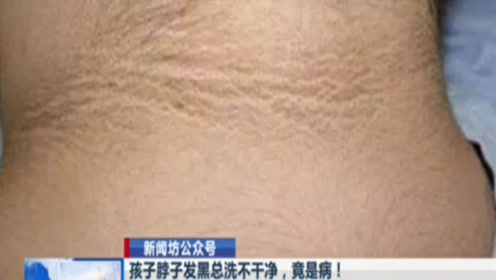 无意中发现孩子的脖子发黑,而且还洗不干净.