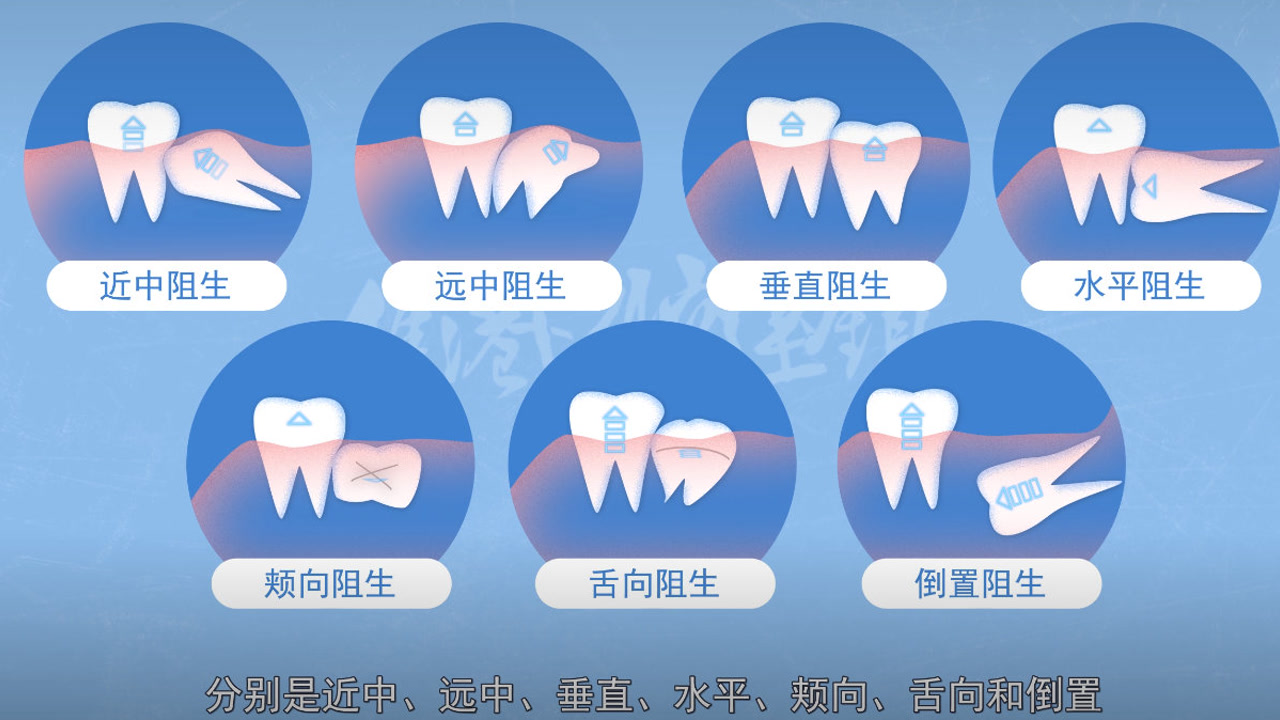 深圳拔智齿科普—阻生智齿有什么类型呢?危害是什么呢?