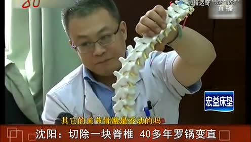 沈阳:切除一块脊椎 40多年罗锅变直
