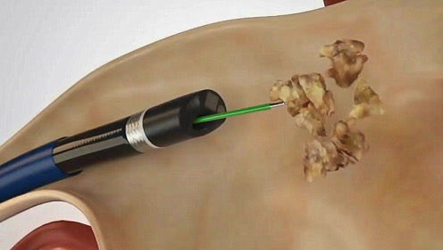 肾结石是怎么取出来的?3d动画演示手术过程,看完感觉肾好疼!