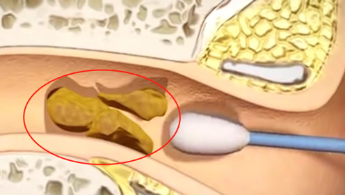 如果15年不掏"耳屎",会有什么样的后果,看完后不敢相信!