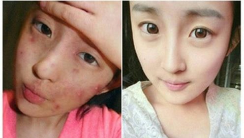 痘印原理是什么_痘印是什么样子的图片