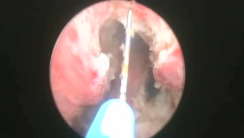尿道内切开术-无删减张家华尿道狭窄专利手术