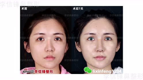 隆鼻失败修复 腾讯视频