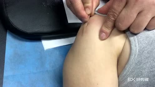 针灸视频  吕晓峰平衡针治疗肩膀筋结节