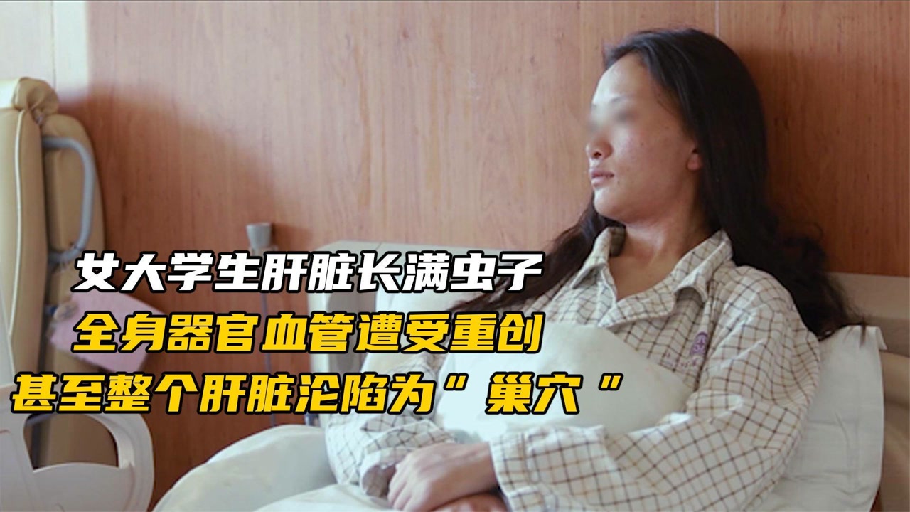 包虫病牧民称之为虫癌,整个肝脏长满虫子,要么换肝要么切掉