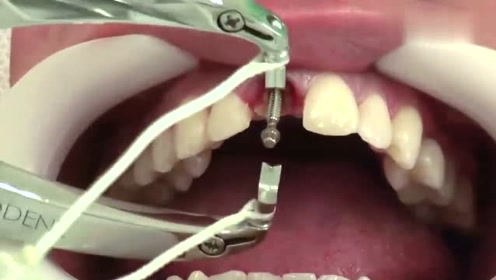 实拍种植牙全过程,看完这个视频,还敢不好好保护自己的牙齿吗?