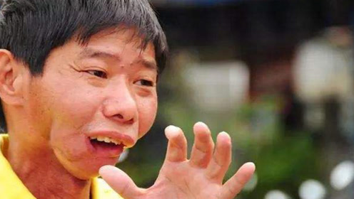 30岁小伙吃槟榔11年,做完手术"半张脸"都没了