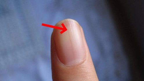 指甲上突然冒出一条黑线,是癌症的征兆?