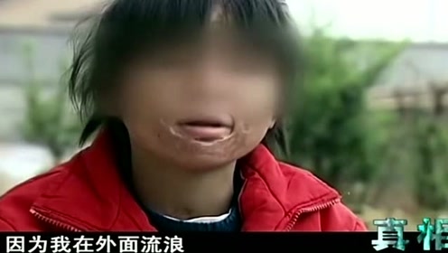 鬼脸女孩被赶出家门,全身上下都是伤疤,看完她的脸吓得寒毛直立!