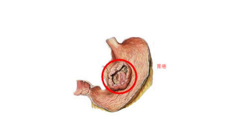 饭后4个迹象,是胃癌来临的信号!别以为只是胃不舒服