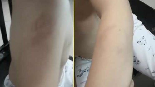 3岁男童咬女老师被以牙还牙,胳膊留牙印淤青,老师:不是故意