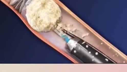 3d还原肾结石手术过程,医生的手都是上帝之手,大多数病都能治愈!