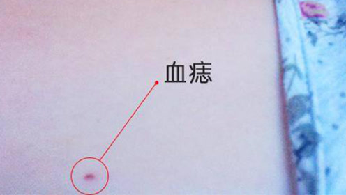 比红痣还吉利10倍!有这种痣大富大贵一辈子
