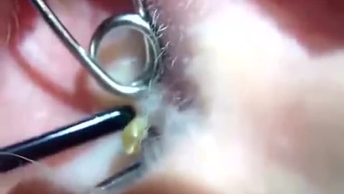 原来耳朵的痘痘是这样挤出来的,看着挺爽mp4