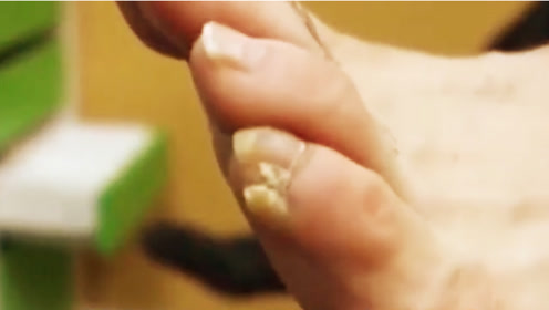 很多中国人的小脚趾都有两瓣指甲?说出的原因你可能不信!
