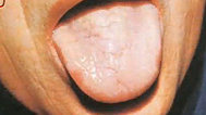 看舌知健康之淡白舌