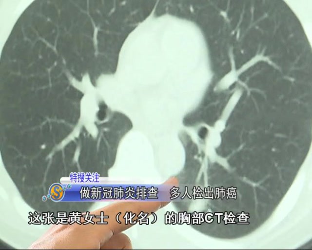 做新冠肺炎排查 多人檢出肺癌