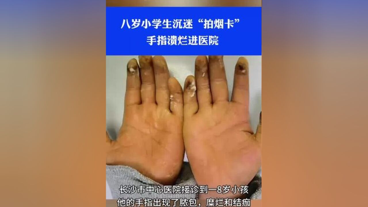 八岁小学生沉迷拍烟卡,手指溃烂进医院