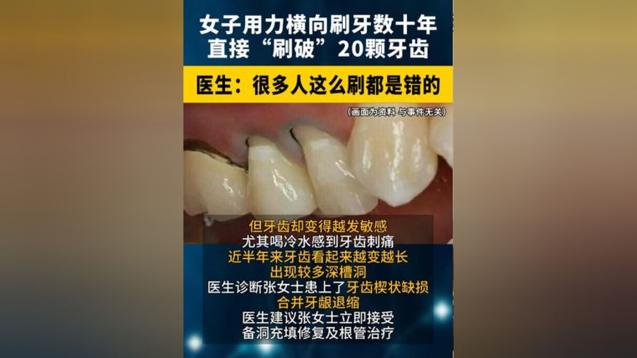 湖北女子用力横向刷牙 数十年,直接“刷破”20颗牙齿 !医生:很多人这么刷都是错的