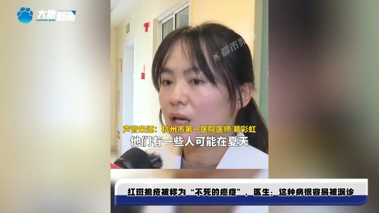 红斑狼疮被称为“不死的癌症”,医生:这种病很容易被漏诊