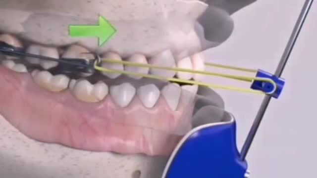 地包天,采用外置牵引矫治器,不需佩戴牙套矫正