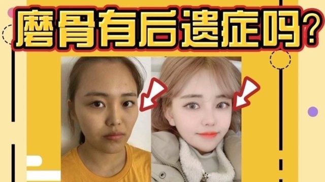 磨骨有什么后遗症?磨骨知识知道多少?