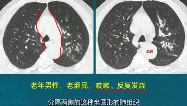 肺癌分中心型和周围型,肺鳞癌多为第1种,跟吸烟有关,早期能治愈