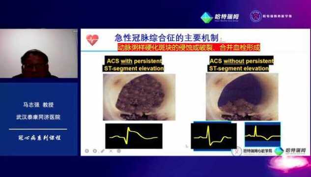 马志强:NSTEMI的临床与治疗原则 |哈特瑞姆心脏学苑课程回顾