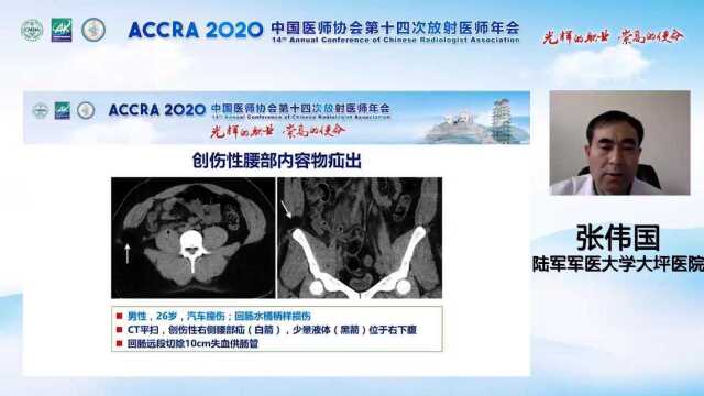 肠道和肠系膜损伤的MDCT诊断大坪医院张伟国