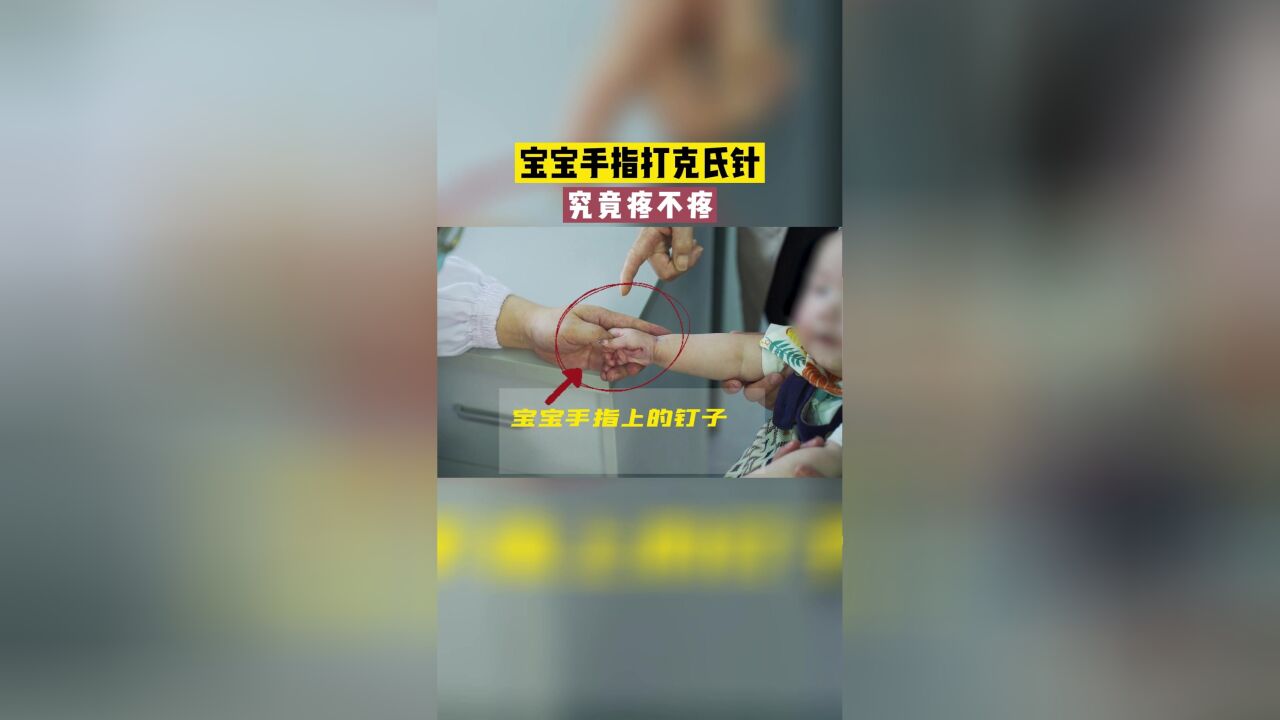 宝宝手指打克氏针,究竟疼不疼