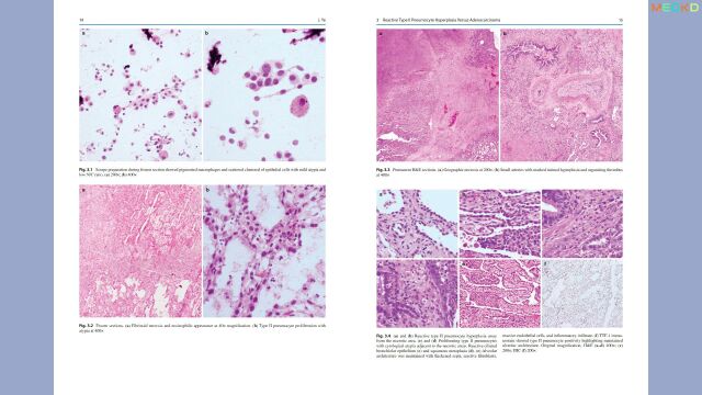 书简:实用肺病理学常见问题Practical Lung Pathology: Frequently Asked Questions