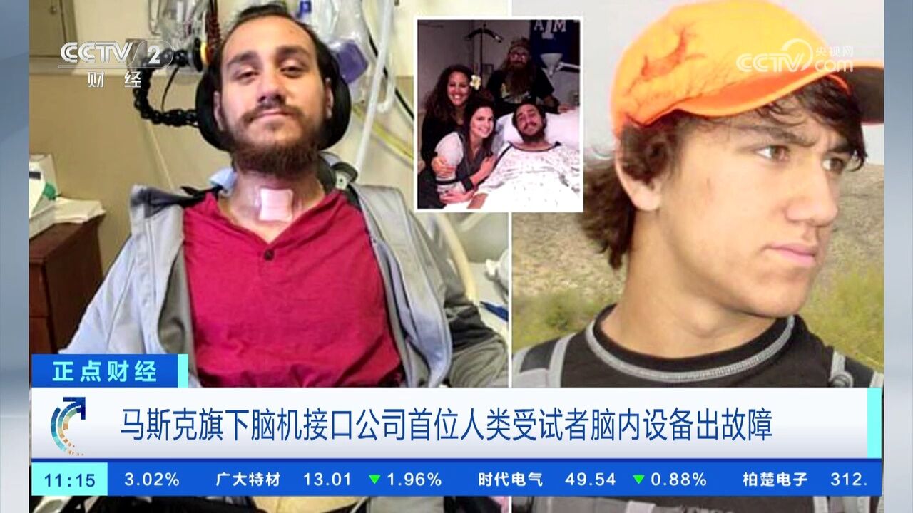 马斯克旗下脑机接口公司首位人类受试者脑内设备出故障