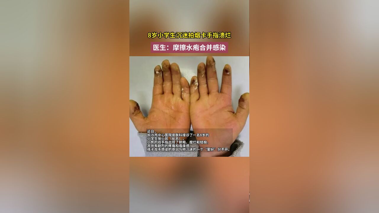 快叫停你家小孩!8岁小学生沉迷拍烟卡手指溃烂