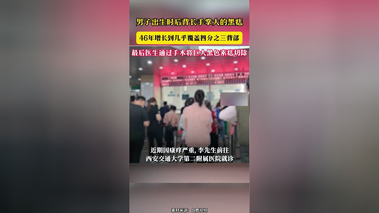 男子出生时后背长手掌大的黑痣 46年增长到几乎覆盖四分之三背部 最后医生通过手术将巨大黑色素痣切除