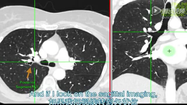 Chest CT- Bronchopulmonary Segments_腾讯视频