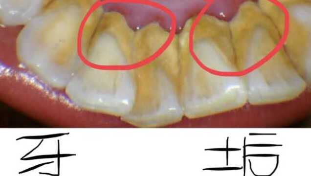 牙垢不用花钱去清理了,刷牙前后用点它,牙垢自动消失,实用又省钱