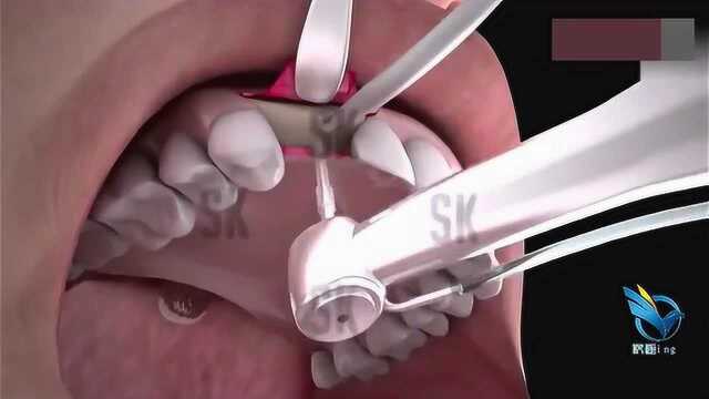 3D动画演示安装假牙全过程,看着都觉得疼!请爱护自己的牙齿