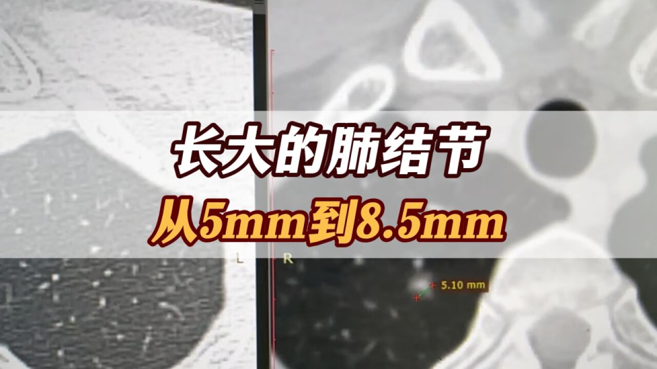 长大的肺磨玻璃结节!从5mm到8.5mm,很危险了吗?