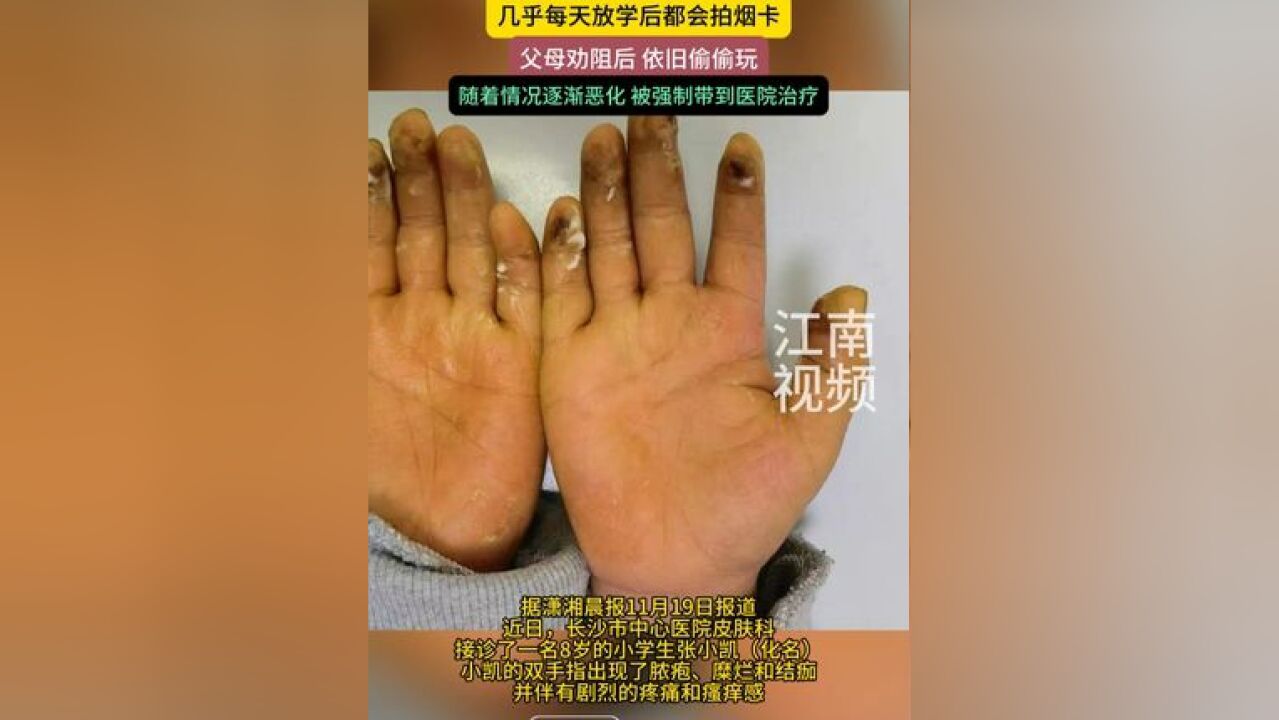 8岁小学生沉迷拍烟卡手指溃烂 ,父母劝阻后,依旧偷偷玩,随着情况逐渐恶化,被强制带到医院治疗