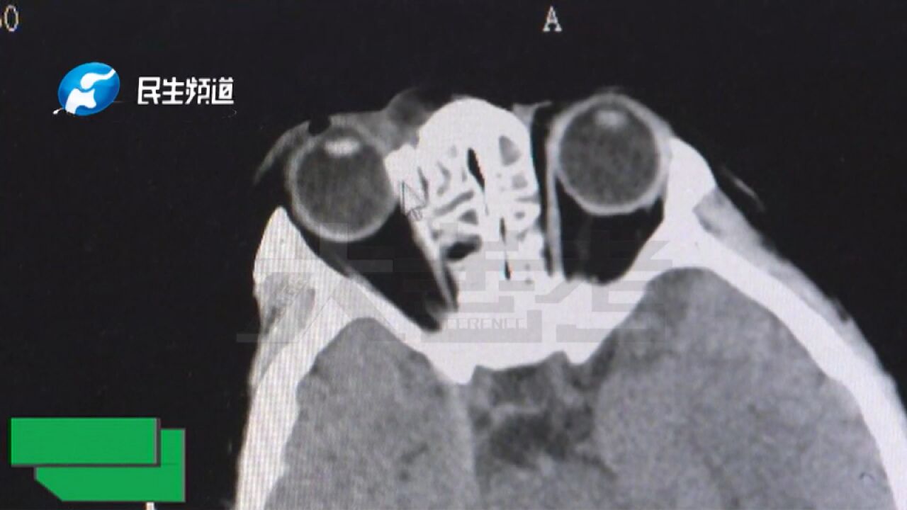 河南郑州:6岁女童吃饭时摔倒,10公分筷子从右眼直入颅脑,医生:与颅内要害仅毫厘之差