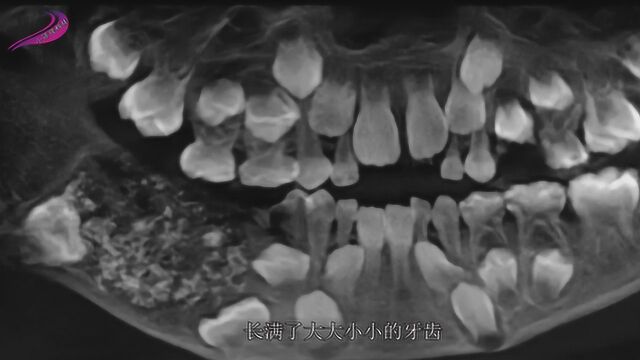 印度男孩患上口腔怪病,拍下X光片后,画面让人起鸡皮疙瘩