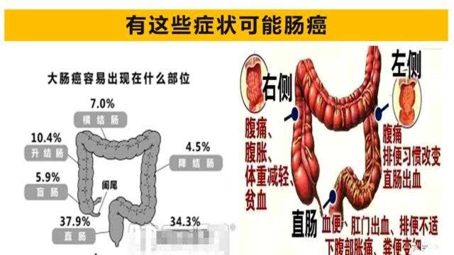 肠癌是怎么回事?有这些症状可能肠癌了,值得重视了