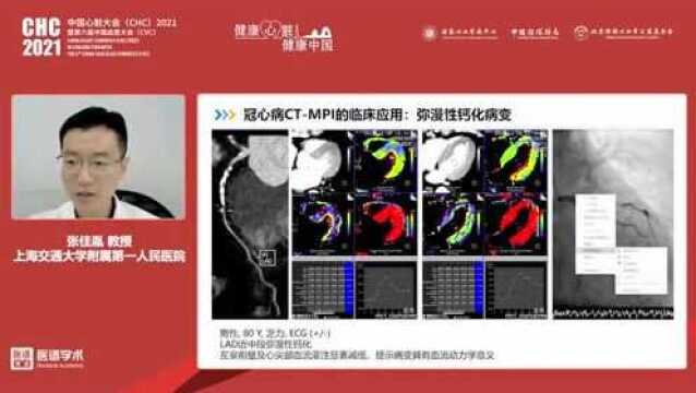 张佳胤教授:心脏CT功能学成像进展从血流灌注到组织定征