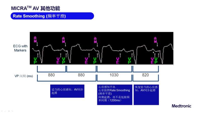 80期无导线micro AV心电图特点(1.2)